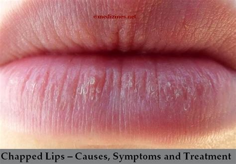 Chapped Lips Causes Symptoms And Treatment