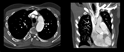 Aortic Perigraft Seroma After Total Arch Replacement—a Diagnostic