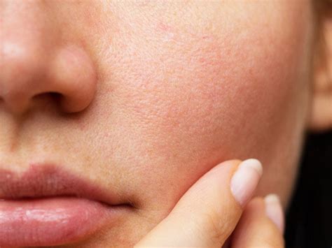 How To Close Open Pores On Face Types Causes Treatment Methods
