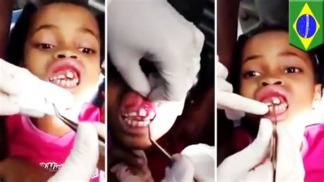 Maggots In Mouth 15 Live Maggots Pulled From Brazilian Girls Gums Youtube
