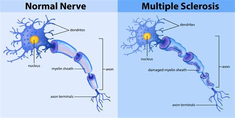 A review of the evidence h. Defining Multiple Sclerosis: What's the Role of Myelin ...