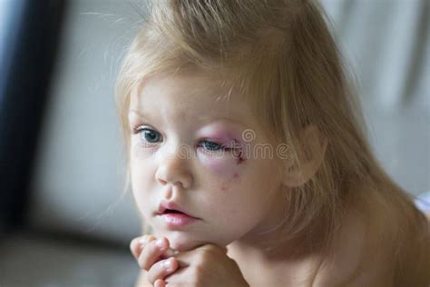 213 Baby Bruise Stock Photos Free And Royalty Free Stock Photos From
