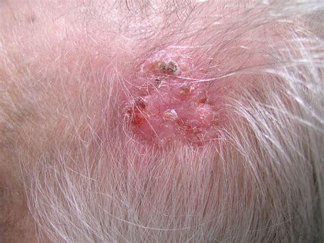 Diagnosis And Removal Of Skin Cancers Of The Face Ceri Hughes Oral