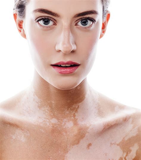 Vitiligo Treatment Queens Ny White Patches On Skin Treatment Bergen