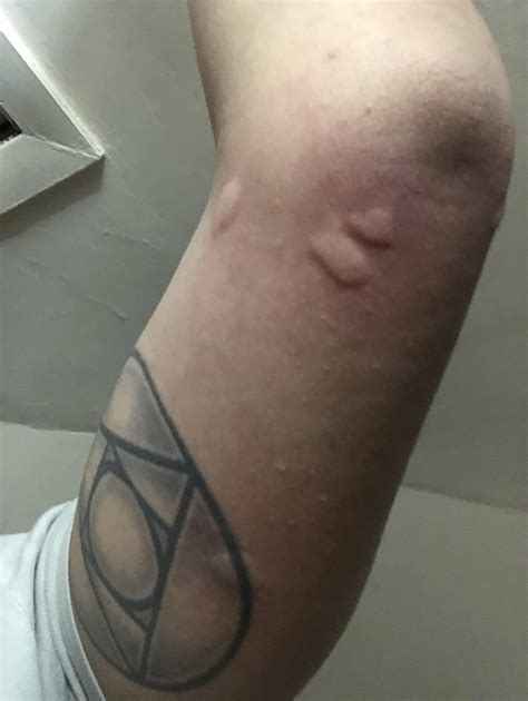 Are These Bed Bug Bites Got Them Just Before I Went To