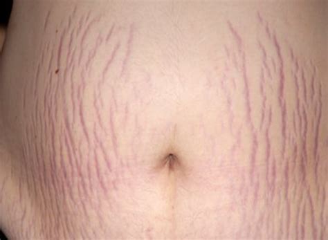 Stretch Marks Treatment Dr Brads Laser And Cosmetic Clinic Bristol