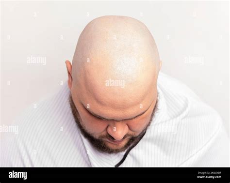 Before And After Bald Head Of A Man Bald Head Of A Man Shaving Bald