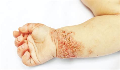 Dermatitis Atópica — Dr Sergio Niklitschek Dermatólogo Puerto Varas