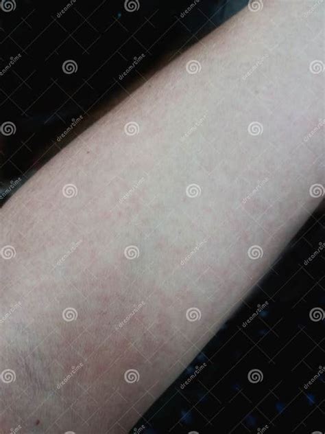 Red Rash On Arms Caused By Allergies Stock Photo Image Of Limb Skin