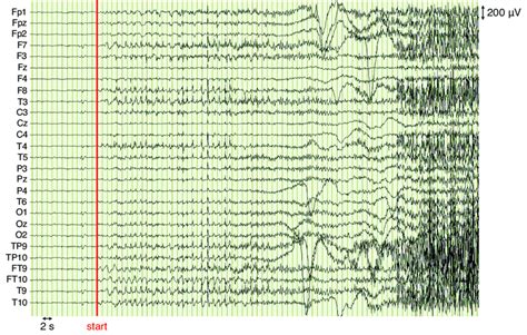 20 Example Of Eeg Seizure Activity The Starting Point Of The Seizure