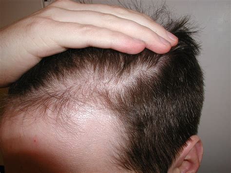 The Key Causes Of Thinning Hair Misery That Strike Millions Daily
