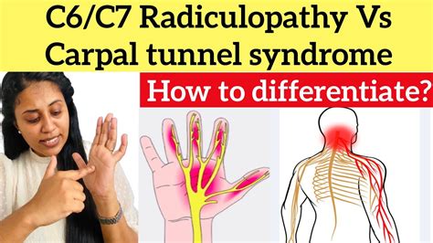 Carpal Tunnel Syndrome Vs Cervical Radiculopathy Carpal My XXX Hot Girl