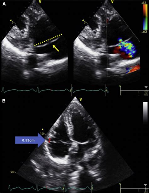 Transthoracic Echocardiography Images Show A Right Ventricular Inflow
