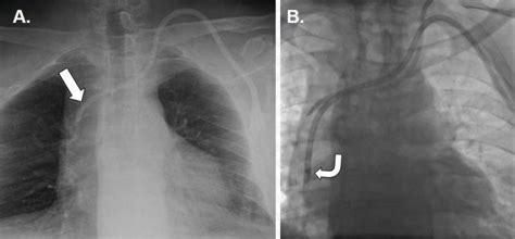 Malposition Of Left Ijv Thc A Chest Radiograph Obtained Due To Poor