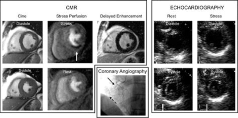 Stress Cardiac Mr Imaging Compared With Stress Echocardiography In The