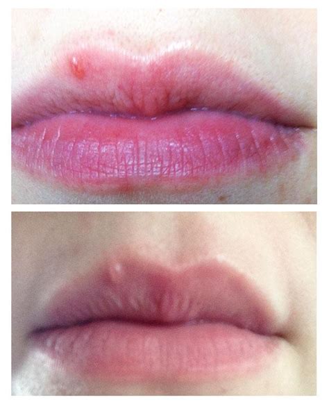 Skin Concern This Bump Has Been On My Lip For Like 10 Years What Is