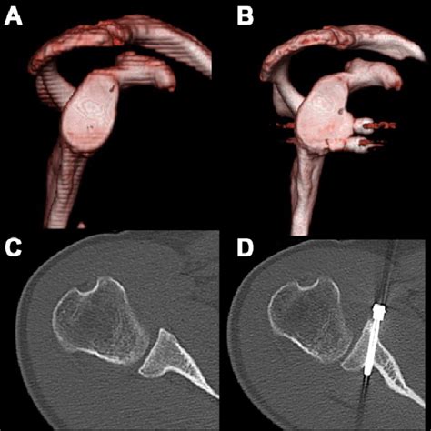 Figure 1 From Arthroscopic Treatment Of Shoulder Instability With