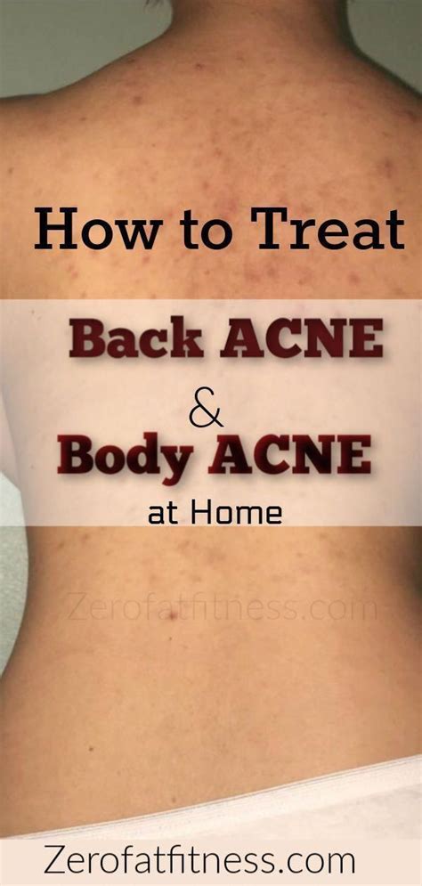 How To Get Rid Of Back Acne Overnight At Home 9 Natural