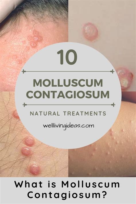 10 Natural Treatments And Home Remedies For Molluscum Contagiosum
