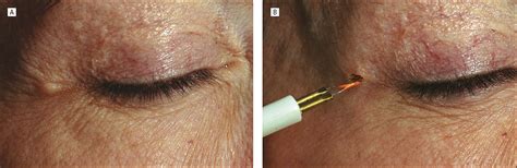 Bump Thermoplasty As A Simple Treatment For Lateral