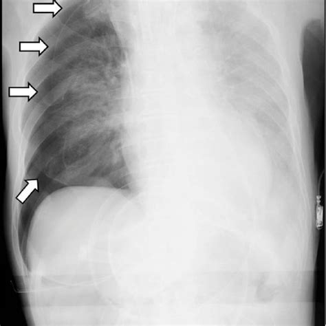 Postoperative Chest X Ray Showed Right Pneumothorax Arrows The Download Scientific Diagram