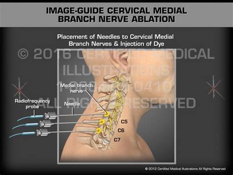 Image Guide Cervical Medial Branch Nerve Ablation Medical Animation