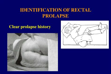 Ppt Rectal Prolapse Clinical Assessment Powerpoint Presentation Free Download Id
