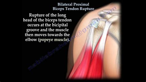 Bilateral Proximal Biceps Tendon Rupture Everything You Need To Know