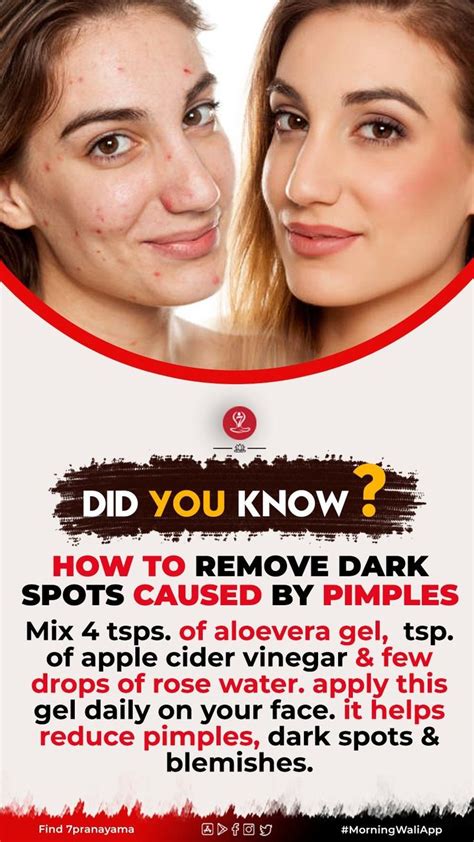 How To Remove Dark Spots Caused By Pimples Remove Dark Spots Pimples