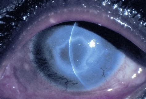 Acanthamoeba Keratitis American Academy Of Ophthalmology