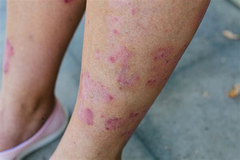 Télescope Déclaration Panique Red Spots On Legs Dévaster Vague Inspection