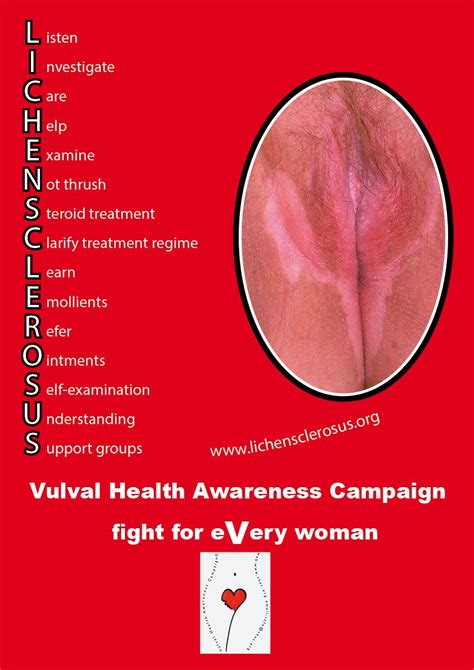 Lichen Sclerosus Poster Check Your Vulva Pinterest Neuer