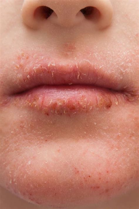 Flaky Skin On Face Around Mouth Red Rash Around Your Mouth Could Be Perioral Dermatitis Here