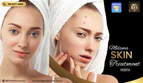 Things To Know About Melasma Skin Treatment And Cool Sculpting By Equinox Beauty And Cosmetic