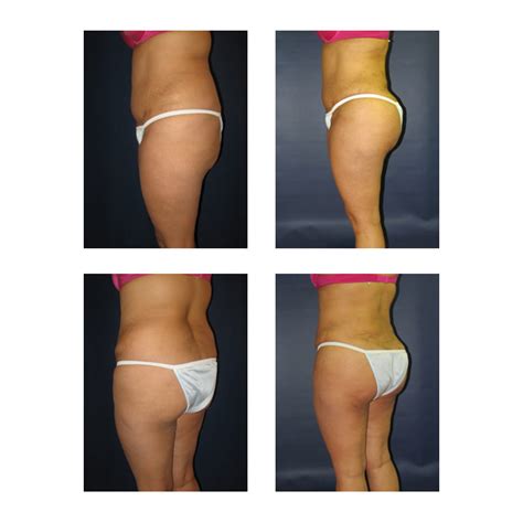Liposuction of full abdomen and waist. YOUR Brazilian Butt Lift Before and After Photos | Matthew ...