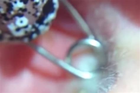 Grim Footage Shows Mr Pimple Removing Cyst From Inside Mans Ear