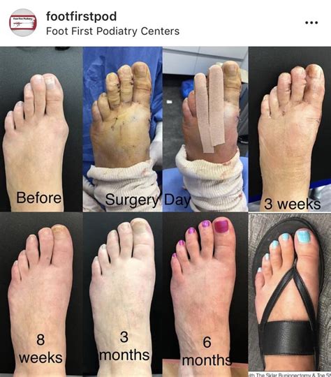 Worth The Results 👣💥 Hammer Toe Surgery Hand Foot And Mouth Bunion