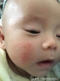 自家宝宝湿疹图片详解婴儿湿疹症状和特点!|湿疹|婴儿湿疹|宝宝_新浪网