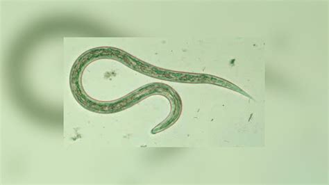 Tennessee Teen Infected By Hookworms During Mission Trip