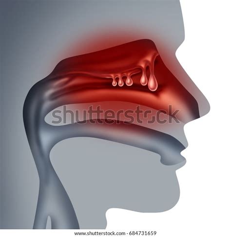 Nasal Polyps Medical Concept Noncancerous Swelling Stock Illustration