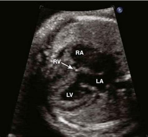 Fetal Echo Simplified 4 Chamber View Sujyotheartclinic
