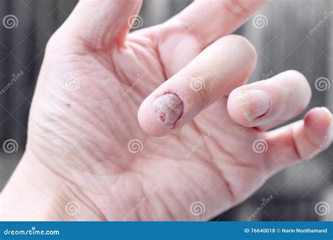 Fungus Infection On Nails Hand Finger With Onychomycosis Soft Focus