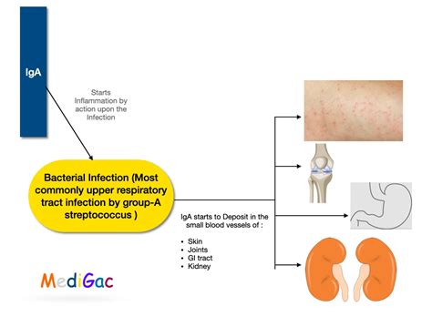 Henoch Schonlein Purpurahsp Clinical Features Pathophysiology