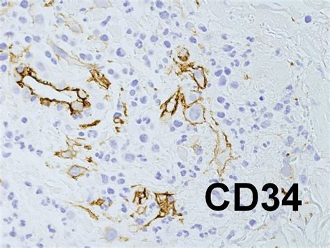 Pathology Outlines Cd34