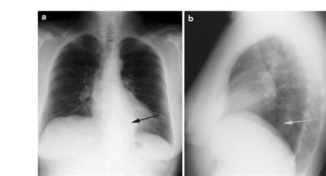 Hiatal Hernia Paraesophageal Type