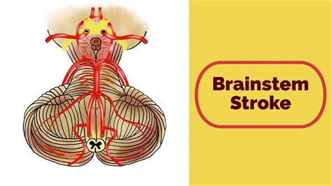 Brainstem Stroke Syndromes Youtube