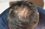 解決頭髮稀疏問題 – Dr. Hair Secret