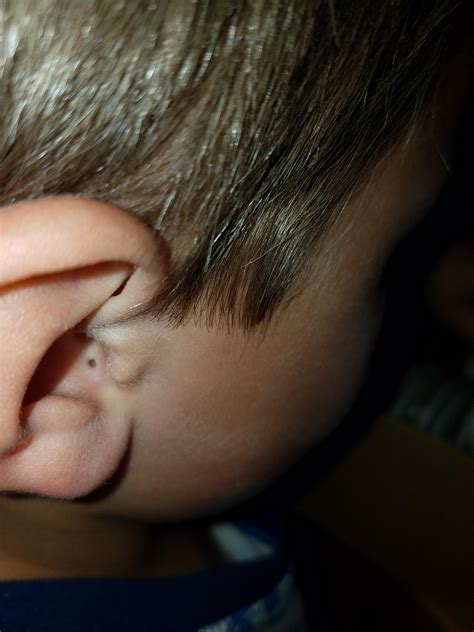 Infected Blackhead In Ear