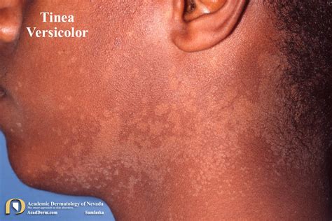 Evoked Scale Sign Of Tinea Versicolor Dermatology Jam