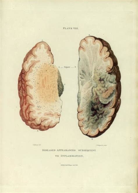 Morbid Anatomy Morbid Anatomy Of The Human Brain Robert Hooper